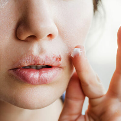 6 Home Remedies for Cold Sores