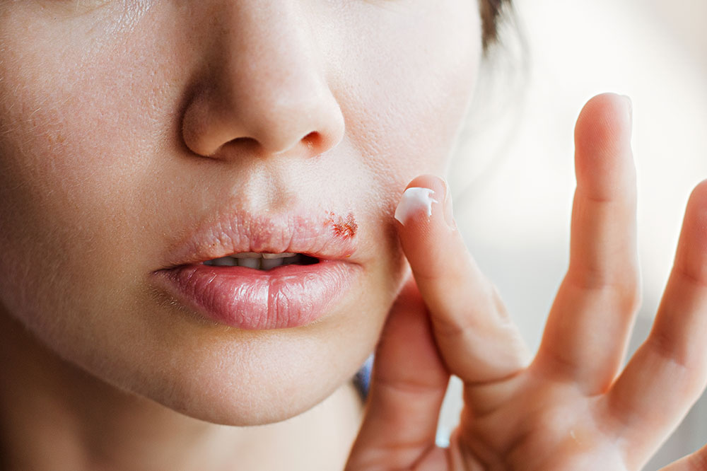 6 Home Remedies for Cold Sores