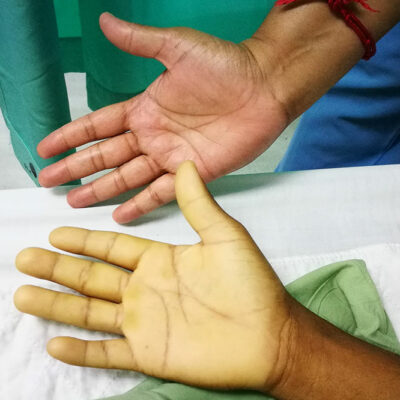 6 Long Term Effects of Anemia