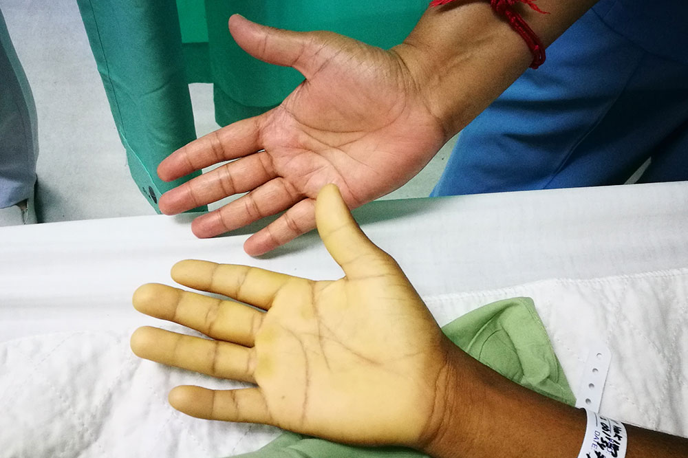 6 Long Term Effects of Anemia