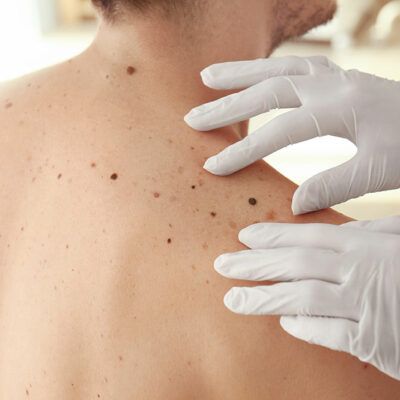 Diagnostic and Treatment Methods for Melanoma