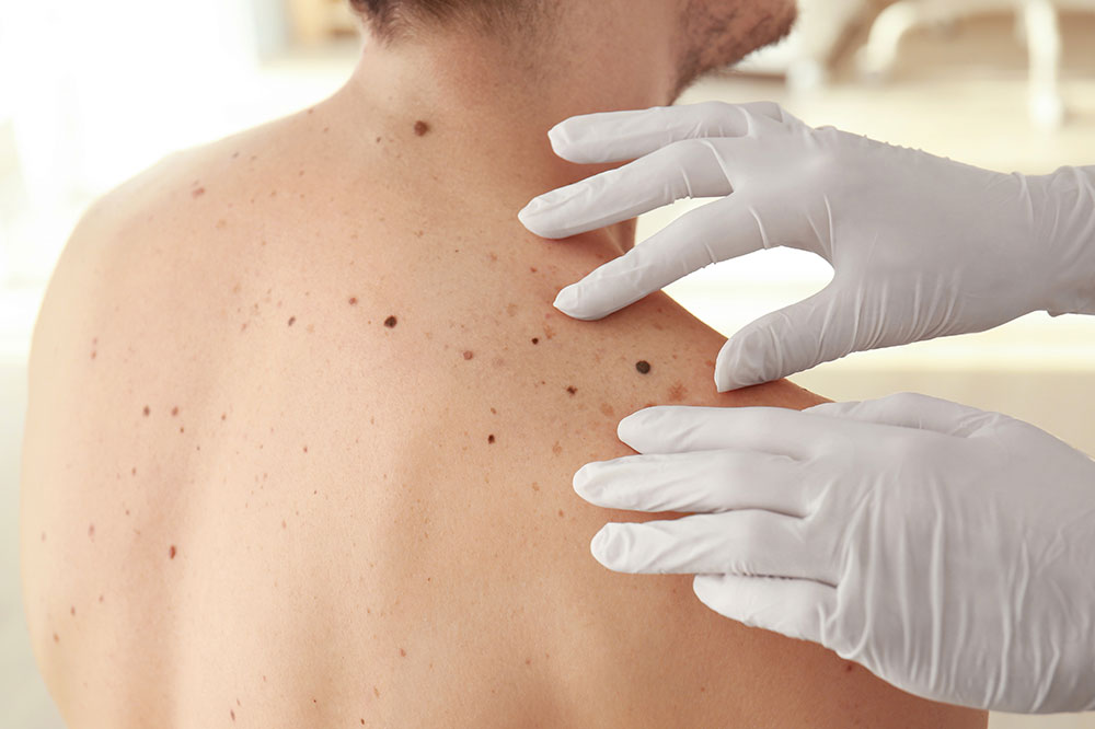 Diagnostic and Treatment Methods for Melanoma