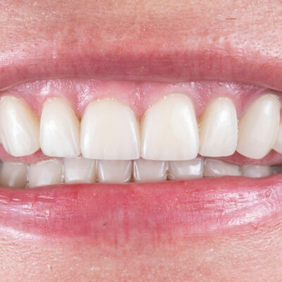 Teeth Whitening – Procedures and Costs