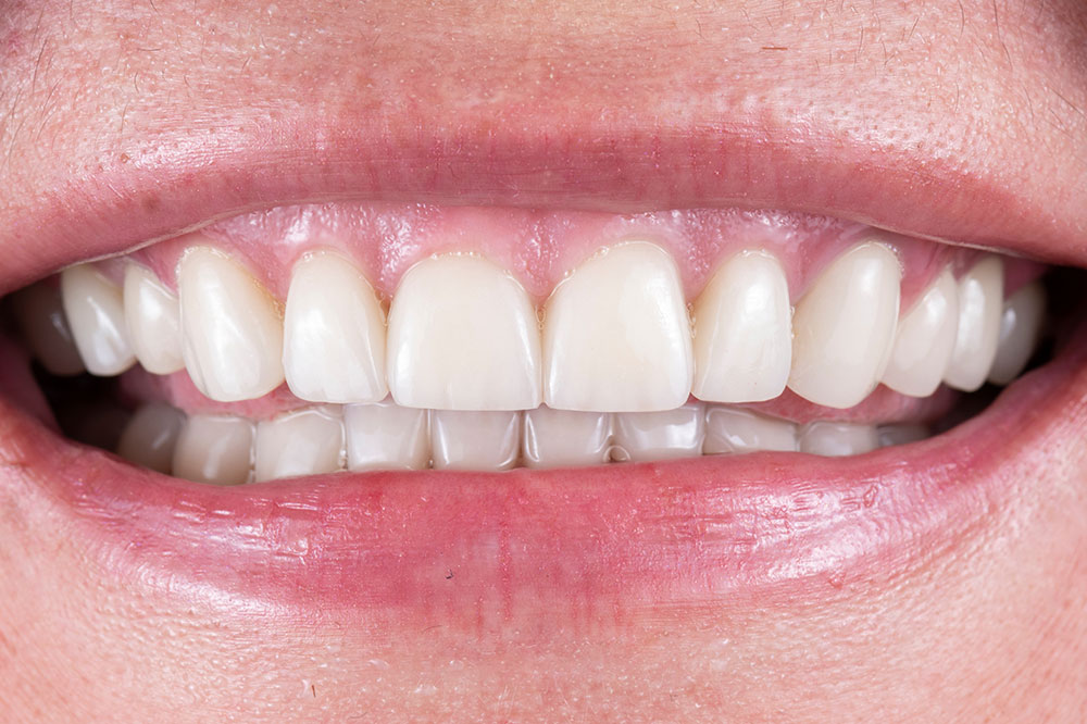 Teeth Whitening – Procedures and Costs